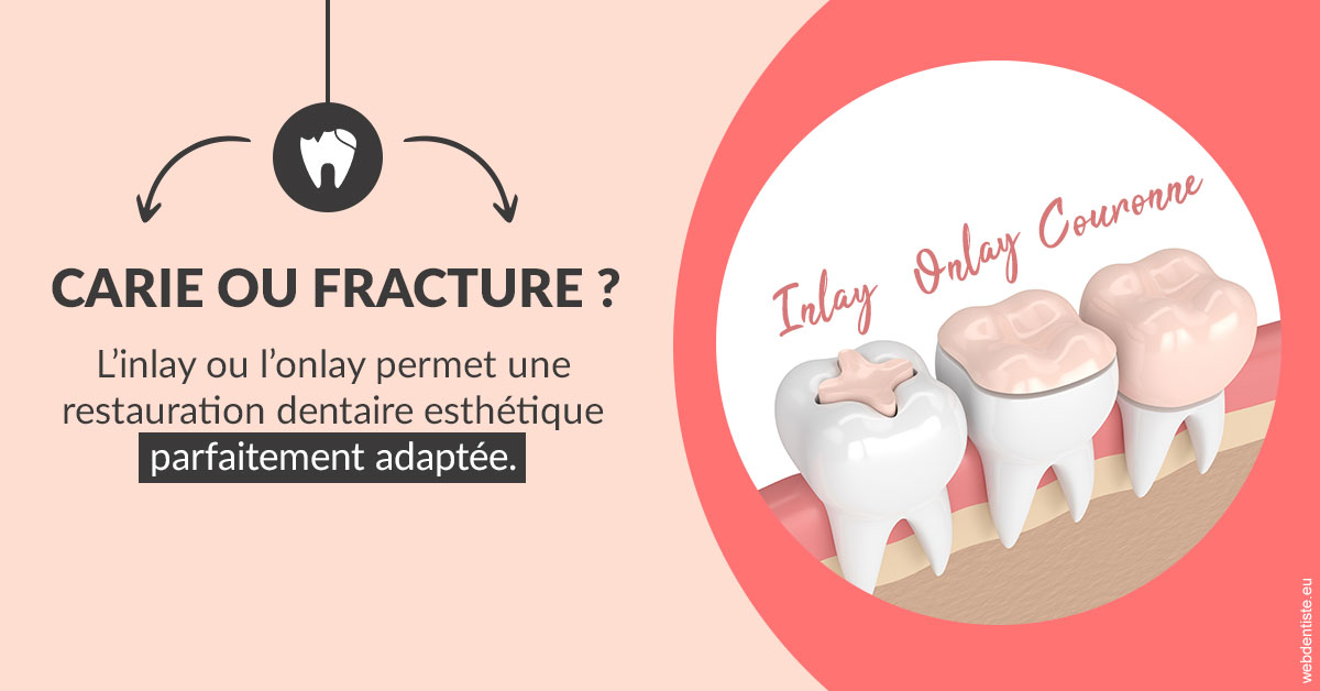https://dr-ann-dorothee-mougin-claudon.chirurgiens-dentistes.fr/T2 2023 - Carie ou fracture 2