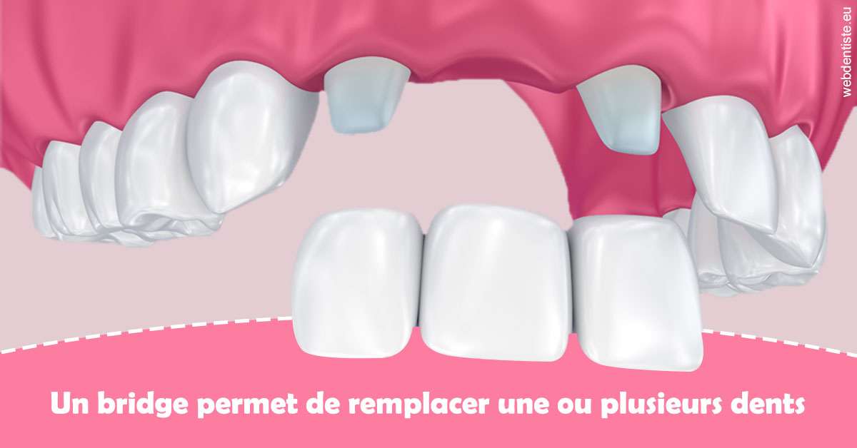 https://dr-ann-dorothee-mougin-claudon.chirurgiens-dentistes.fr/Bridge remplacer dents 2
