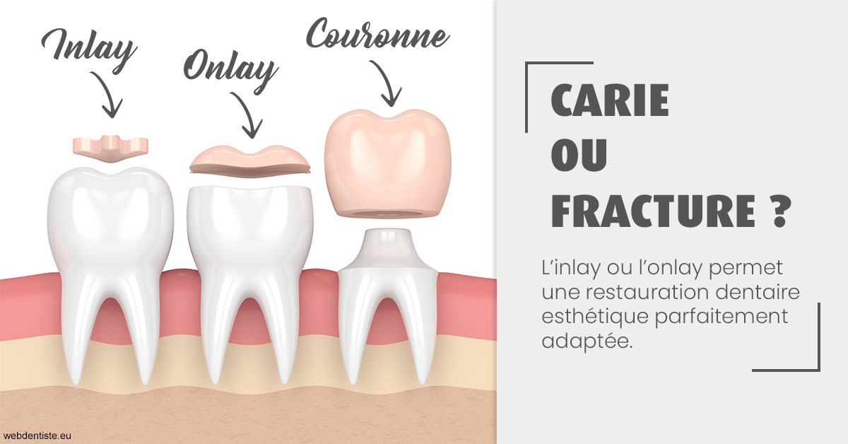 https://dr-ann-dorothee-mougin-claudon.chirurgiens-dentistes.fr/T2 2023 - Carie ou fracture 1