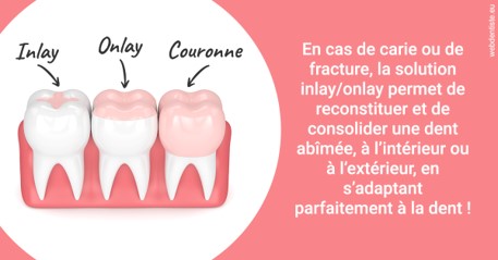 https://dr-ann-dorothee-mougin-claudon.chirurgiens-dentistes.fr/L'INLAY ou l'ONLAY 2
