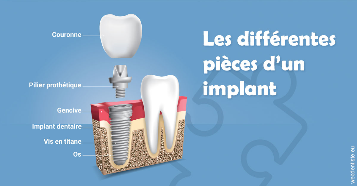 https://dr-ann-dorothee-mougin-claudon.chirurgiens-dentistes.fr/Les différentes pièces d’un implant 1